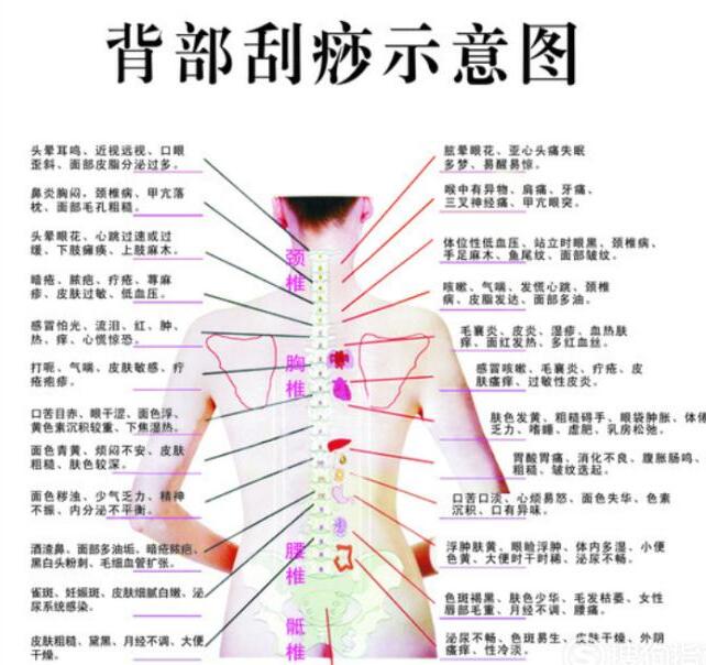 中醫(yī)背部刮痧示意圖